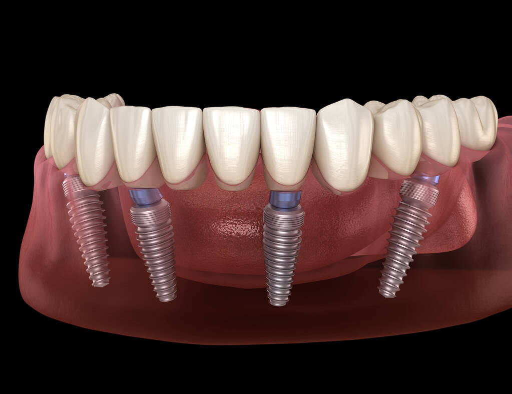 Full Mouth Dental Implants Cost & Procedure in Australia